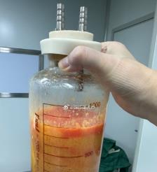 商丘水动力吸脂手术要做多久？